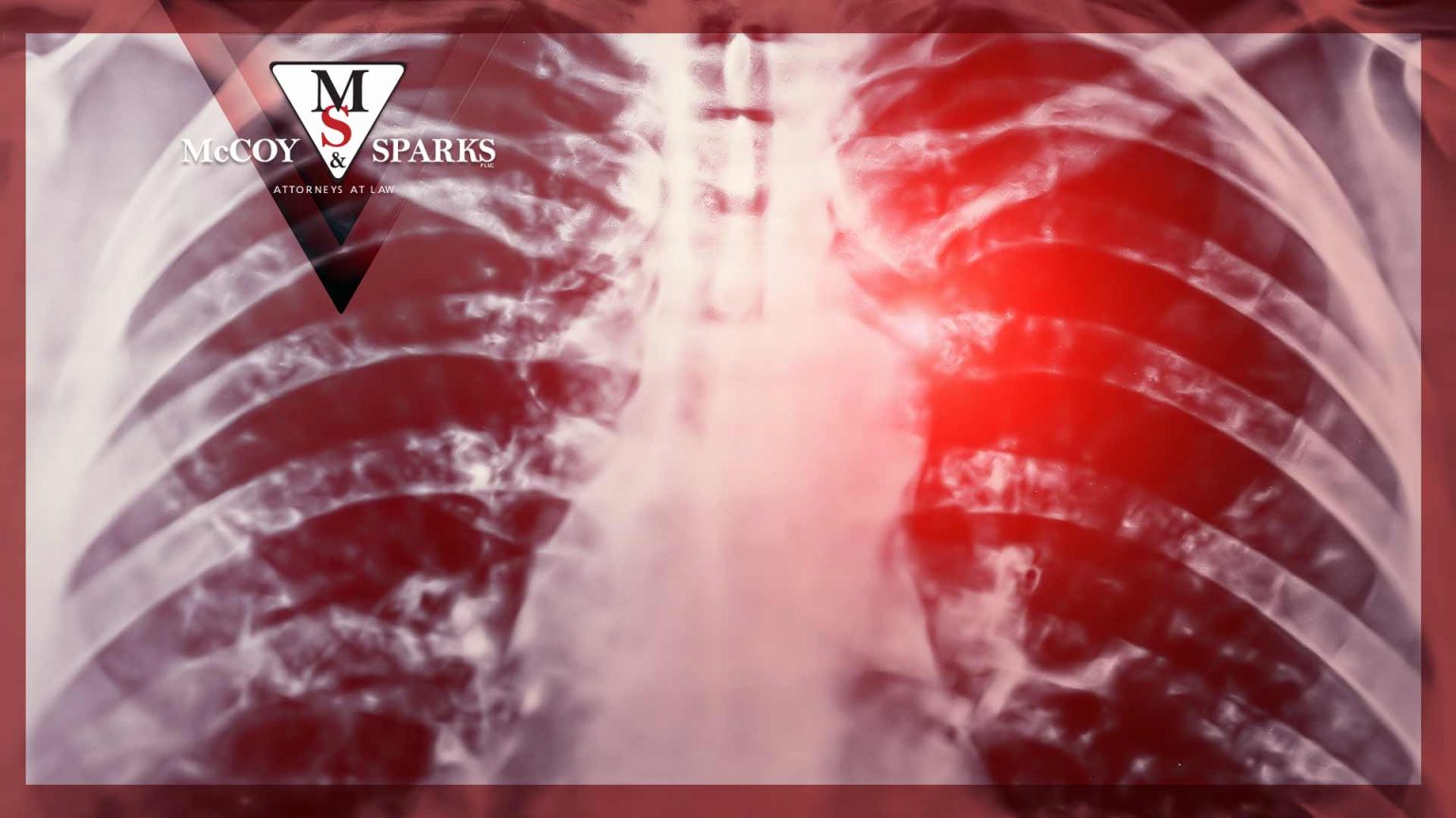 Broken Rib Car Accident Injury Claim